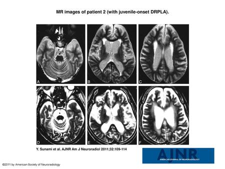 MR images of patient 2 (with juvenile-onset DRPLA).