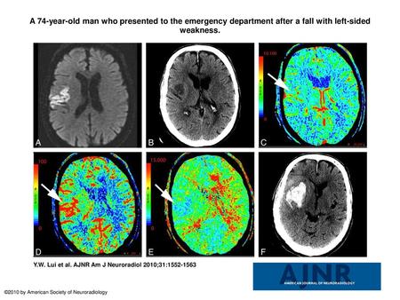 A 74-year-old man who presented to the emergency department after a fall with left-sided weakness. A 74-year-old man who presented to the emergency department.