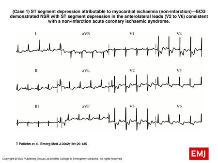 (Case 1) ST segment depression attributable to myocardial ischaemia (non-infarction)—ECG demonstrated NSR with ST segment depression in the anterolateral.