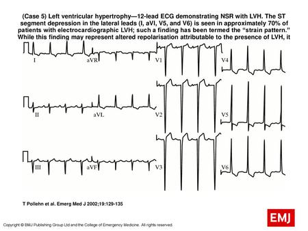 (Case 5) Left ventricular hypertrophy—12-lead ECG demonstrating NSR with LVH. The ST segment depression in the lateral leads (I, aVl, V5, and V6) is seen.