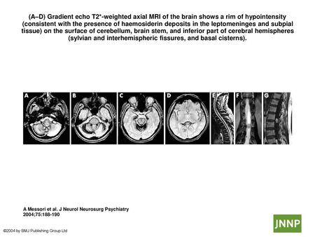 (A–D) Gradient echo T2*-weighted axial MRI of the brain shows a rim of hypointensity (consistent with the presence of haemosiderin deposits in the leptomeninges.