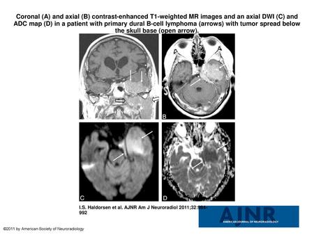 Coronal (A) and axial (B) contrast-enhanced T1-weighted MR images and an axial DWI (C) and ADC map (D) in a patient with primary dural B-cell lymphoma.