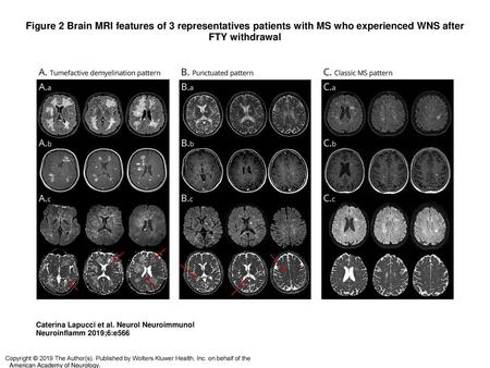 Figure 2 Brain MRI features of 3 representatives patients with MS who experienced WNS after FTY withdrawal Brain MRI features of 3 representatives patients.