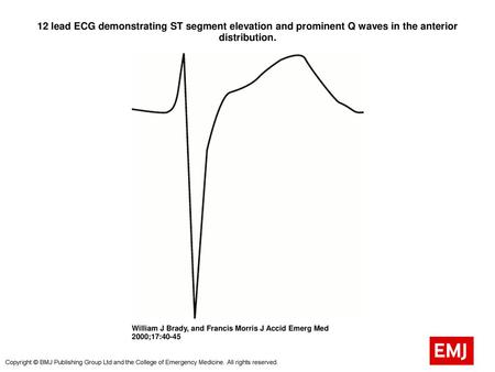 12 lead ECG demonstrating ST segment elevation and prominent Q waves in the anterior distribution. 12 lead ECG demonstrating ST segment elevation and prominent.