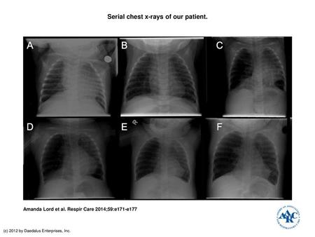 Serial chest x-rays of our patient.