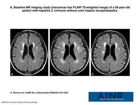 A, Baseline MR imaging study (transverse fast FLAIR T2-weighted image) of a 56-year-old patient with hepatitis C cirrhosis without overt hepatic encephalopathy.
