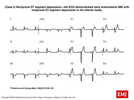 (Case 2) Reciprocal ST segment depression—the ECG demonstrated early anterolateral AMI with reciprocal ST segment depression in the inferior leads. (Case.