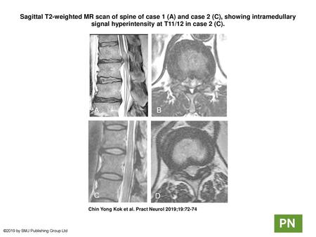 Sagittal T2-weighted MR scan of spine of case 1 (A) and case 2 (C), showing intramedullary signal hyperintensity at T11/12 in case 2 (C). Sagittal T2-weighted.