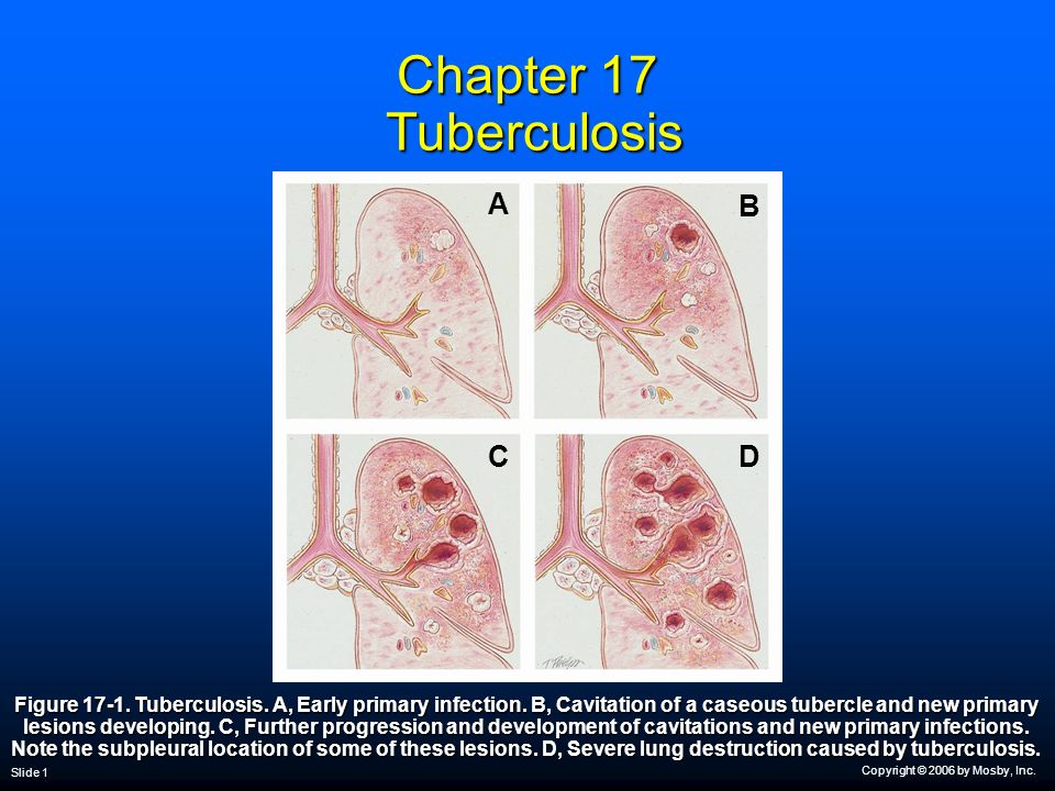 tubercle tuberculosis