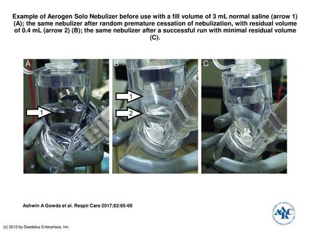 Example of Aerogen Solo Nebulizer before use with a fill volume of 3 mL normal saline (arrow 1) (A); the same nebulizer after random premature cessation.