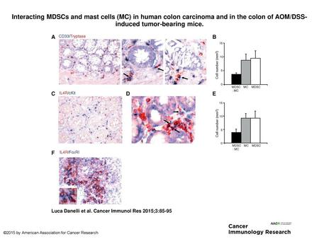 Interacting MDSCs and mast cells (MC) in human colon carcinoma and in the colon of AOM/DSS-induced tumor-bearing mice. Interacting MDSCs and mast cells.