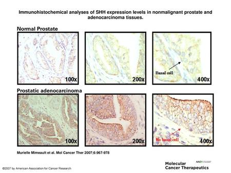 Immunohistochemical analyses of SHH expression levels in nonmalignant prostate and adenocarcinoma tissues. Immunohistochemical analyses of SHH expression.