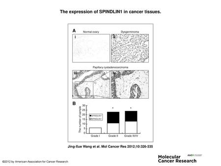 The expression of SPINDLIN1 in cancer tissues.