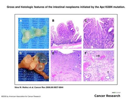 Gross and histologic features of the intestinal neoplasms initiated by the Apc1638N mutation. Gross and histologic features of the intestinal neoplasms.