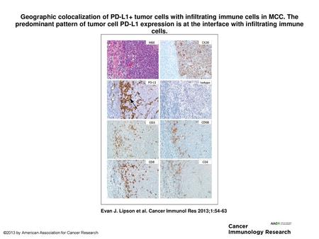 Geographic colocalization of PD-L1+ tumor cells with infiltrating immune cells in MCC. The predominant pattern of tumor cell PD-L1 expression is at the.