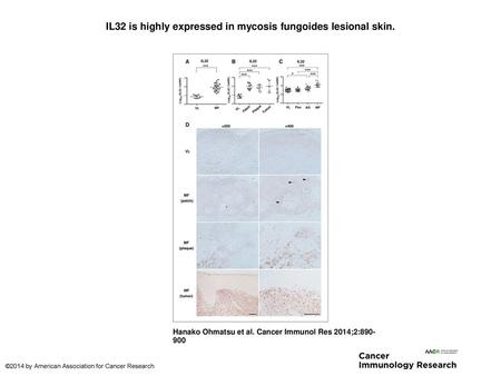 IL32 is highly expressed in mycosis fungoides lesional skin.