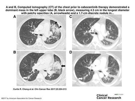 A and B, Computed tomography (CT) of the chest prior to cabozantinib therapy demonstrated a dominant mass in the left upper lobe (B, black arrow), measuring.