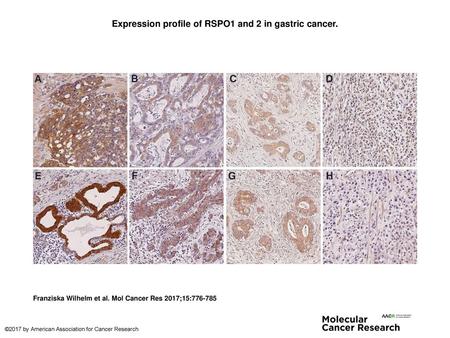 Expression profile of RSPO1 and 2 in gastric cancer.
