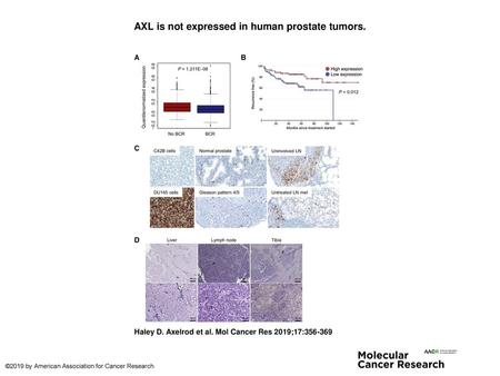 AXL is not expressed in human prostate tumors.