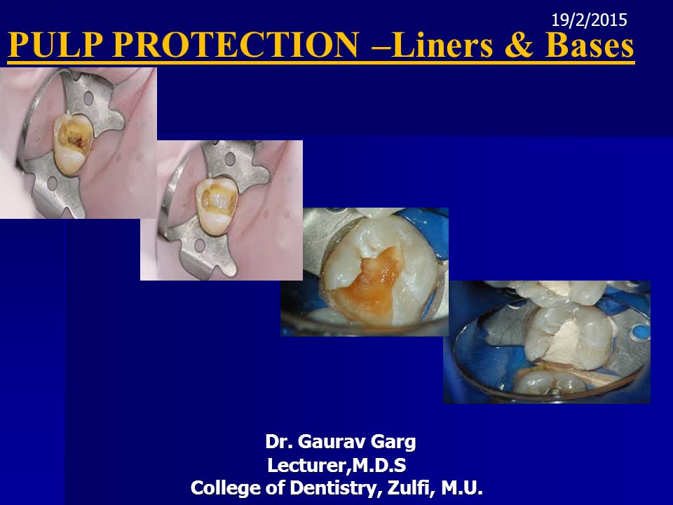 liners and bases in dentistry