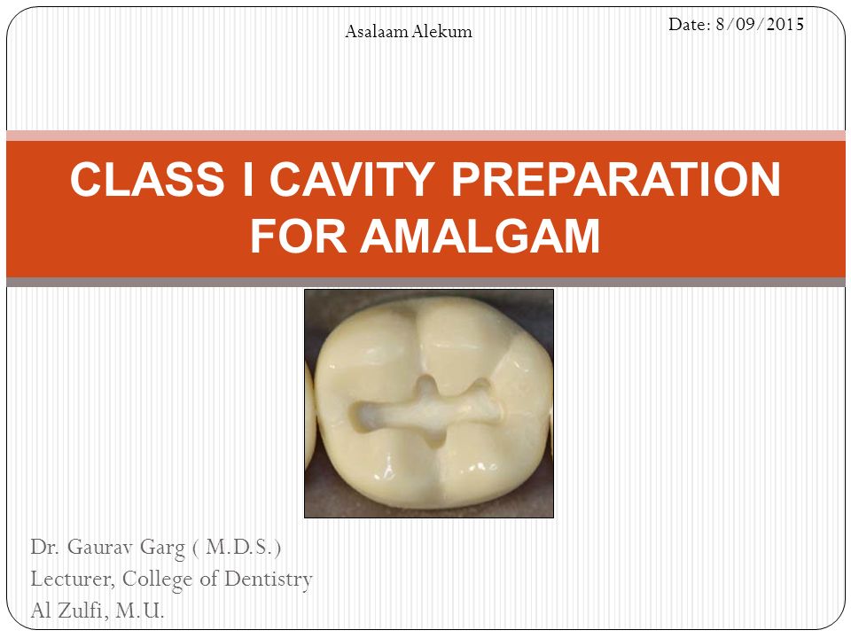 CLASS I CAVITY PREPARATION FOR AMALGAM - ppt video online download
