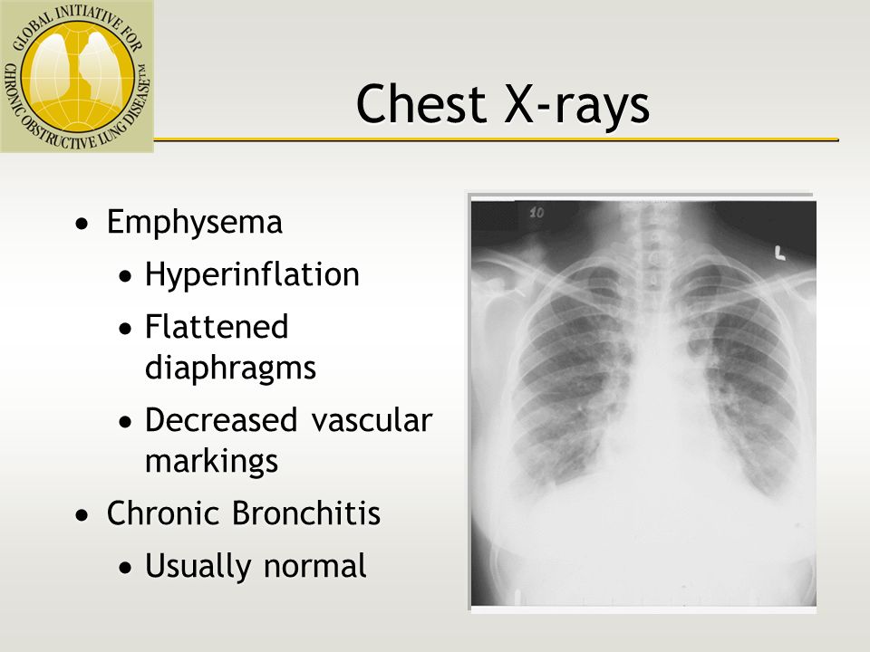 Chronic Obstructive Pulmonary Disease - ppt video online 