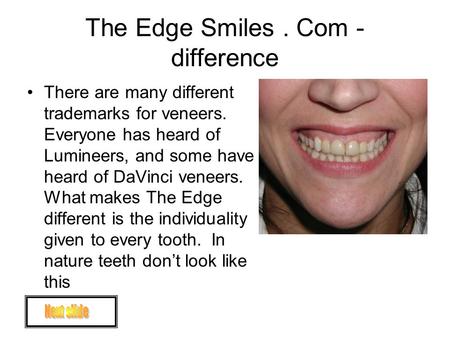 The Edge Smiles. Com - difference There are many different trademarks for veneers. Everyone has heard of Lumineers, and some have heard of DaVinci veneers.