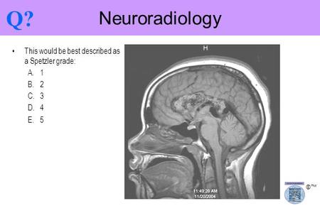 Q? Neuroradiology This would be best described as a Spetzler grade: 1