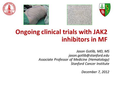 Ongoing clinical trials with JAK2 inhibitors in MF