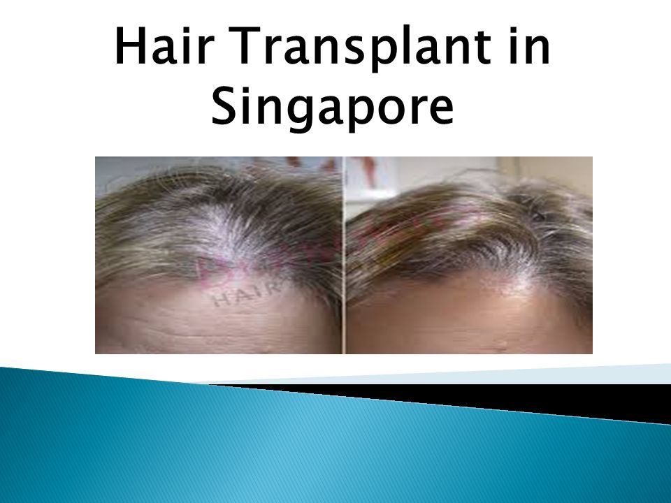 Hair Transplant in Singapore. DHT Or Genes; What Causes Hair Loss? A Review  From Scalp Technology In Singapore There are many arguments and debates  happening. - ppt download