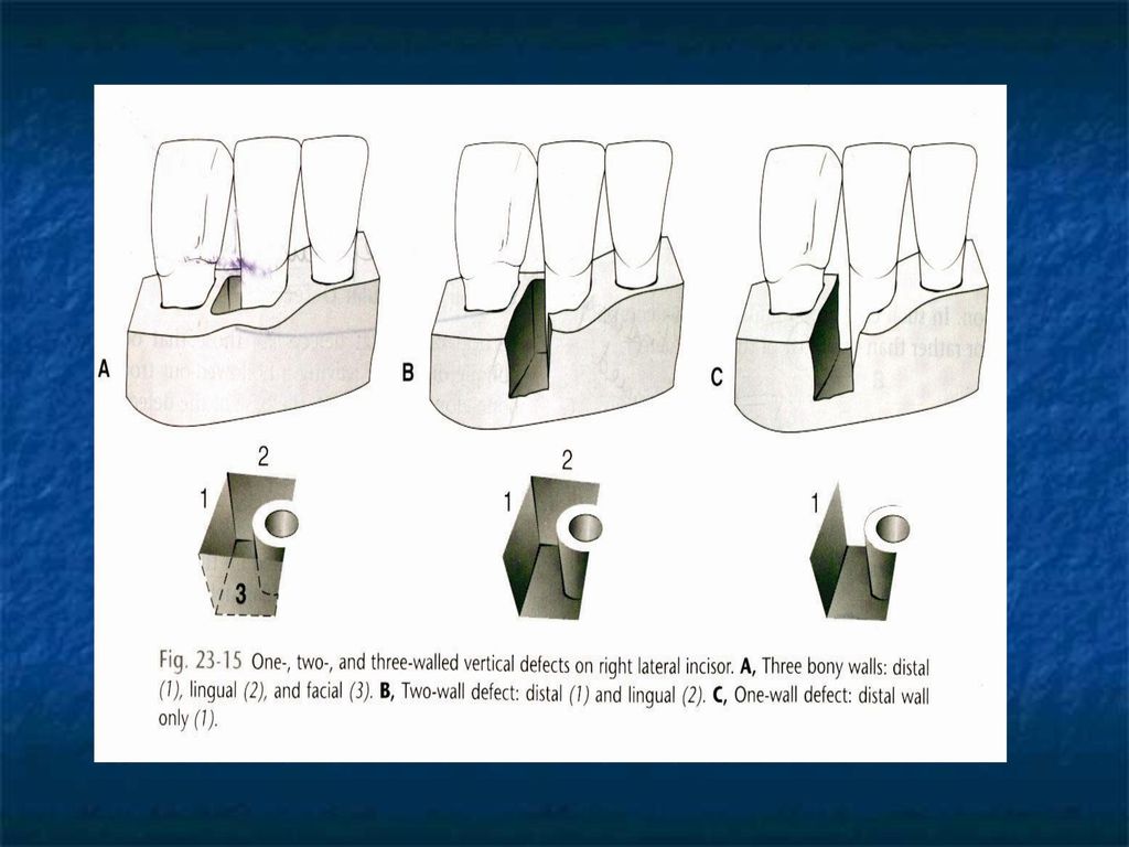 Bone Loss Patterns Of Bone Destruction Ppt Video Online Download Bone Loss Patterns Of Bone Destruction Ppt Video Online Download