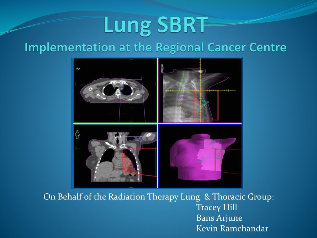 Lung Sbrt Implementation At The Regional Cancer Centre Ppt Download