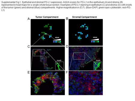 Tumor CompartmentStromal Compartment mask C D EF A B Supplemental Fig 1. Epithelial and stromal PD-L1 expression. AQUA scores for PD-L1 in the epithelium.