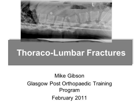 Mike Gibson Glasgow Post Orthopaedic Training Program February 2011 Thoraco-Lumbar Fractures.