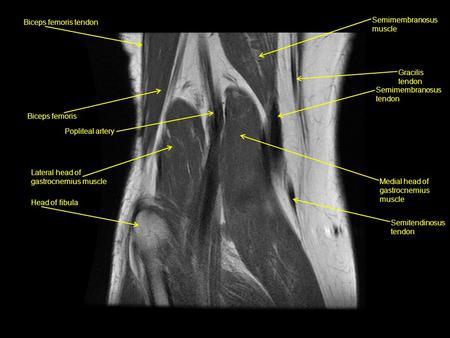 Biceps femoris tendon Biceps femoris Popliteal artery Lateral head of gastrocnemius muscle Head of fibula Semimembranosus muscle Gracilis tendon Semimembranosus.