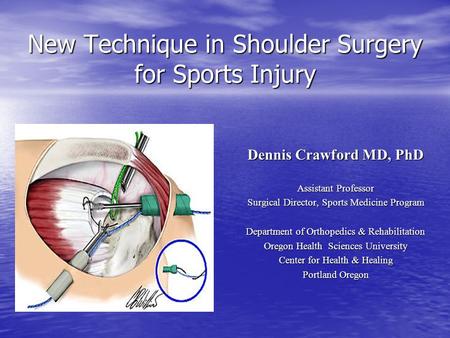 New Technique in Shoulder Surgery for Sports Injury Dennis Crawford MD, PhD Assistant Professor Surgical Director, Sports Medicine Program Department of.