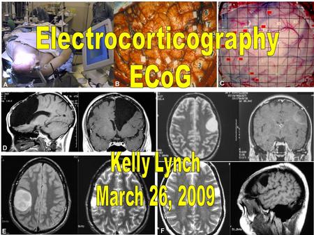 Electrocorticography,or ECoG, is the practice of using electrodes placed directly on the exposed surface of the brain, after conducting a craniotomy.