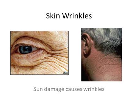 Sun damage causes wrinkles