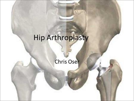 Hip Arthroplasty Chris Oser. Presentation Why hip replacement? How? –Surgery! Different materials Pros and Cons Resurfacing Patient post-op.