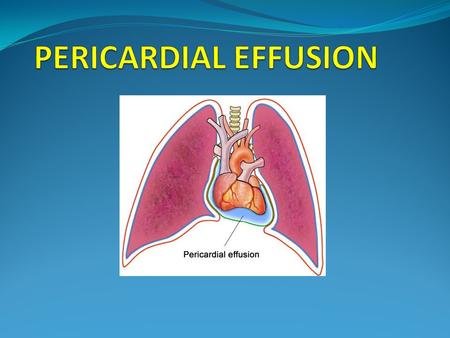 INTRODUCTION Presence of abnormal amount and/or character of fluid in the pericardial space Can be caused by LOCAL/SYSTEMIC/IDIOPATHIC causes Can be ACUTE.