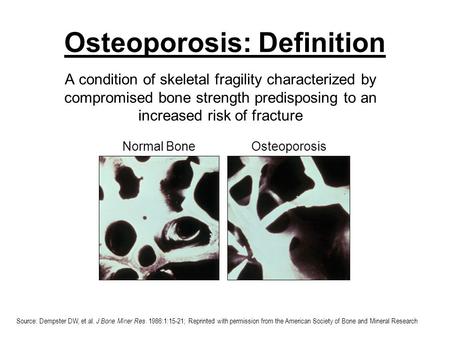 Osteoporosis: Definition A condition of skeletal fragility characterized by compromised bone strength predisposing to an increased risk of fracture NIH.