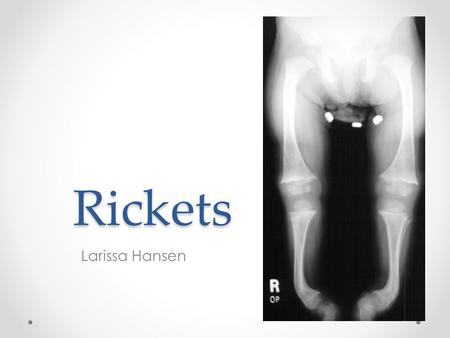 Rickets Larissa Hansen. Definition Rickets is the softening and weakening of bones in children, usually because of an extreme and prolonged vitamin D.