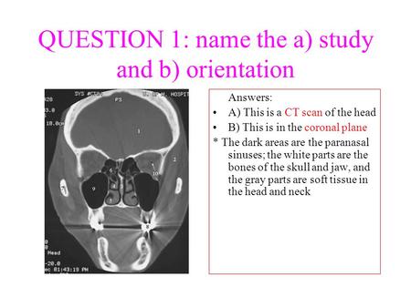 QUESTION 1: name the a) study and b) orientation Answers: A) This is a CT scan of the head B) This is in the coronal plane * The dark areas are the paranasal.