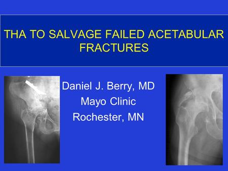 THA TO SALVAGE FAILED ACETABULAR FRACTURES