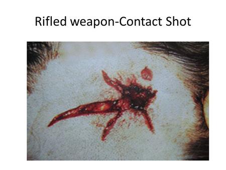 Rifled weapon-Contact Shot. Rifled Weapon Entry wound: Contact shot - No Scorching, blackening or tattooing. The wound may be triangular, stellate or.