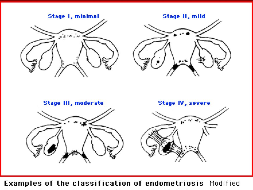 Ejercicios endometriosis