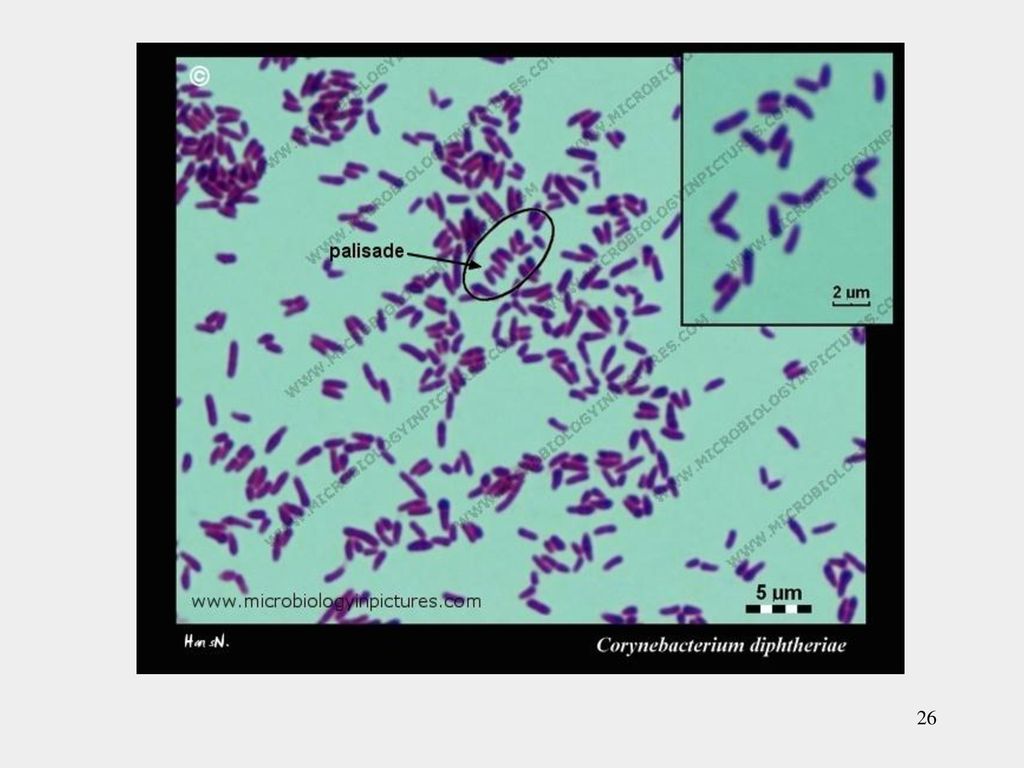 Дифтероиды в мазке на флору. Коринебактерии дифтерии по Граму. Коринебактерии дифтерии мазок. Коринебактерии дифтерии в мазке. Дифтерийная палочка по Граму.