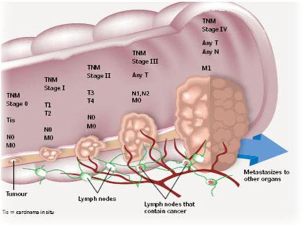 4 стадия рака кишки с метастазами. Опухоли ободочной кишки классификация. ТНМ классификация опухолей ободочной кишки. Классификация опухоли прямой кишки TNM.