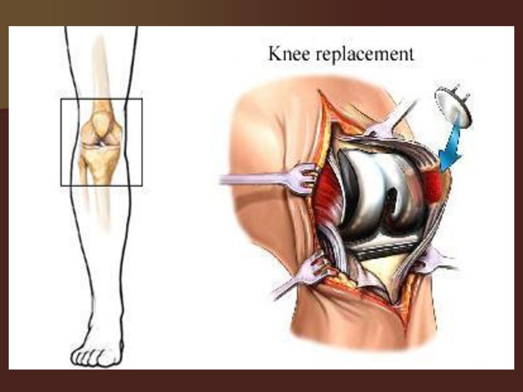 Операции на коленном суставе стоимость. Эндопротезирование при артрозе коленного сустава. Эндопротезирование тазобедренного сустава шрам. Операция на крестообразной связки коленного сустава. После операции эндопротезирования коленного сустава.