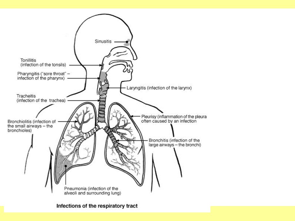 Патологии дыхательных путей. Инфекции верхних дыхательных путей этиология. Острая респираторная инфекция нижних дыхательных путей. Профилактика заболеваний нижних дыхательных путей. Инфекции нижних дыхательных путей таблица.